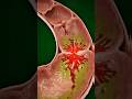 Stomach Ulcer