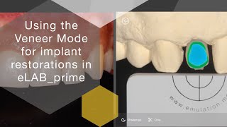 Using the veneer mode for implant restorations in eLAB_prime. Copyright © 2020 by Sascha Hein screenshot 5