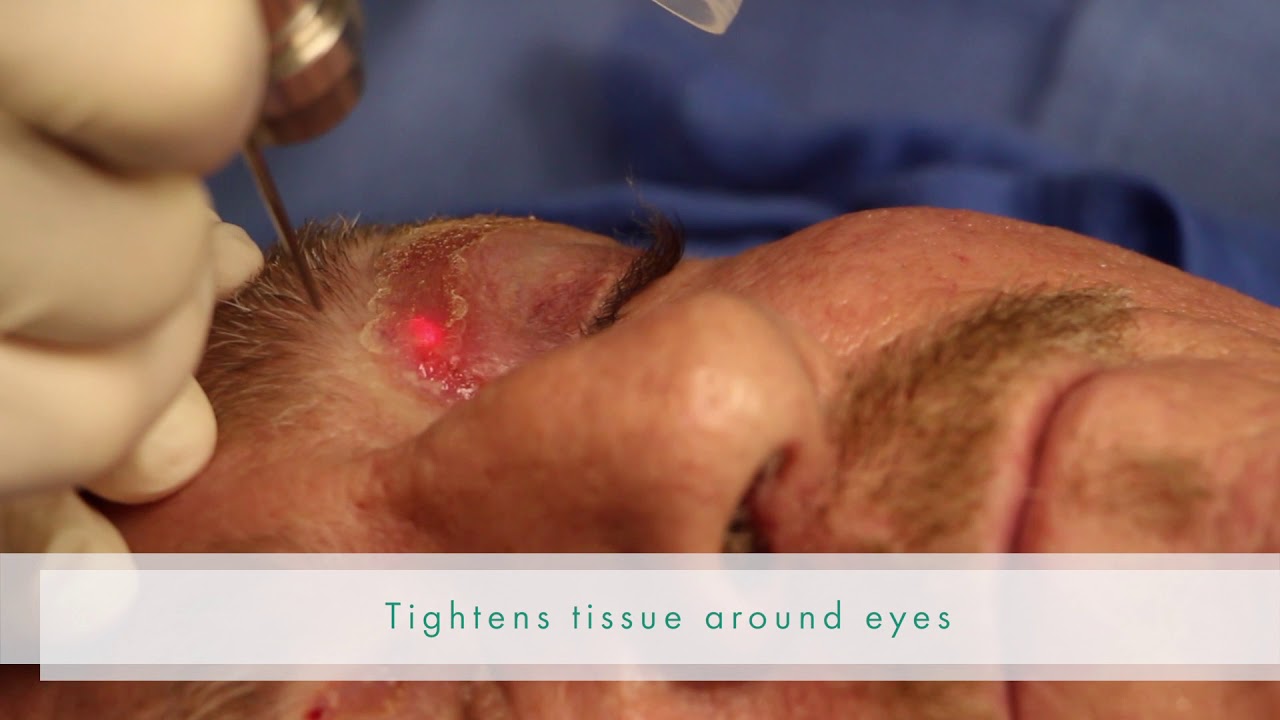 Banner for Sciton Laser to the Eyelids with Dr. Goldman