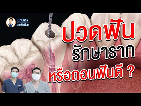 ปวดฟัน!! ถอนหรือรักษารากฟันดี ? | คลายปัญหา รากฟันเทียม กับ หมอโชค