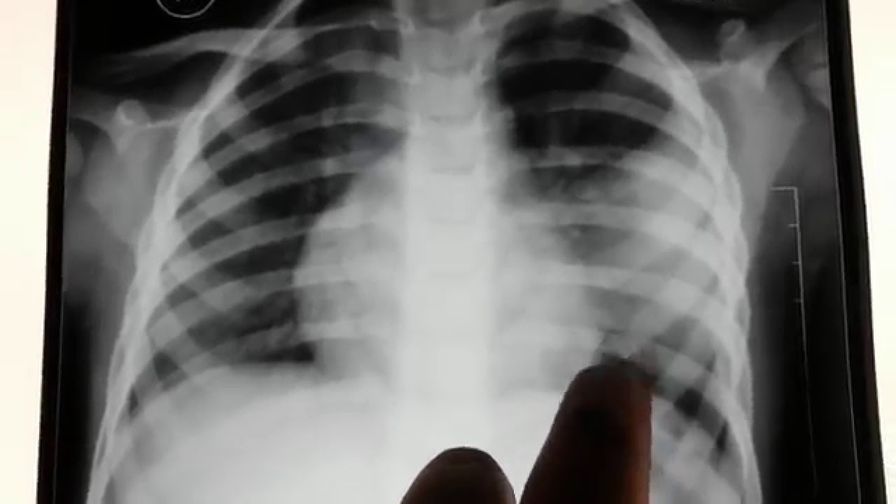 Left Lower Lobe Pneumonia With Consolidation YouTube left-lower-lobe-pneumonia-with-consolidation-youtube