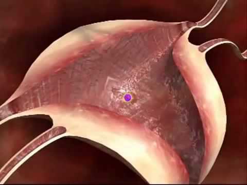 Video: Bagaimanakah anda dapati ovari silinder berlubang?