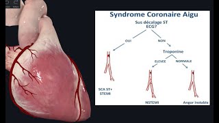 10 Mins Pour Comprendre Le Syndrome Coronaire Aigu