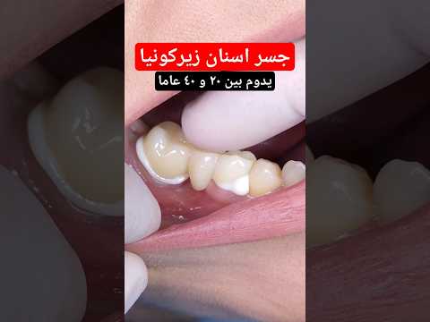 جسر اسنان زيركونيا لا ينكسر