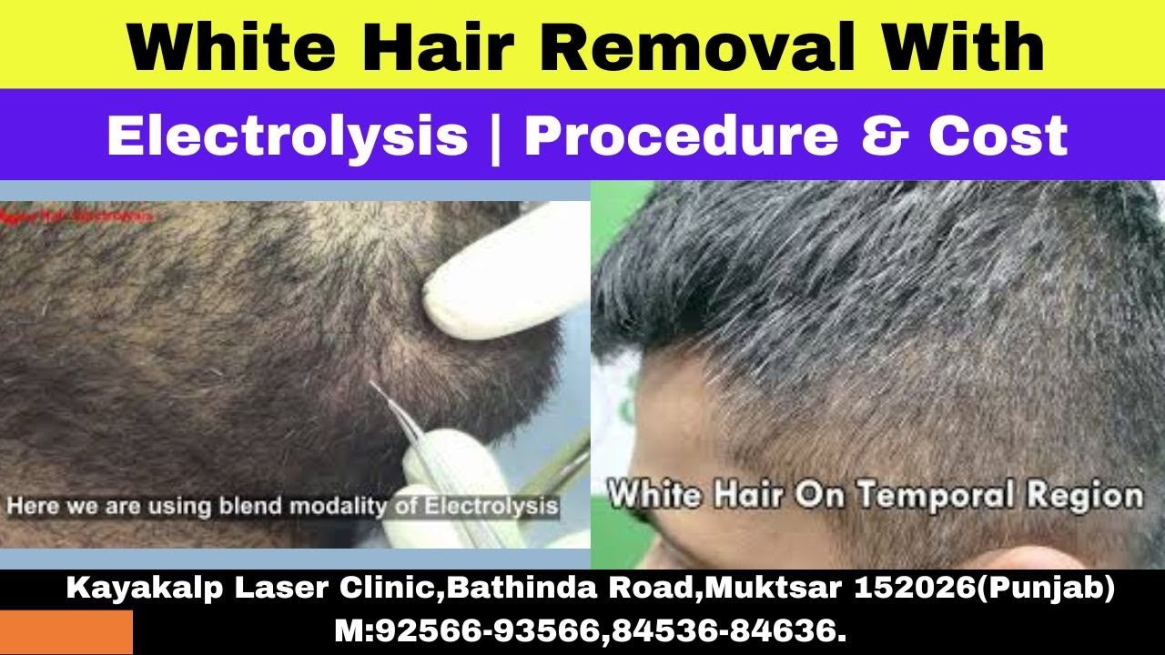 White Hair Removal With Electrolysis | Procedure & Cost