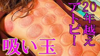 吸い玉治療 瘀血 産まれた時からアトピーに苦しむ女子をひかるが救います グラン治療院 ブエノスカリン院 Youtube 吸い玉治療 瘀血 産まれた時からアトピーに苦しむ女子をひかるが救います グラン治療院 ブエノスカリン院 Youtube