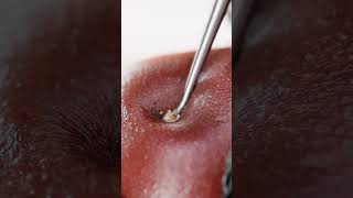 Super satisfying blackhead removal!️ Model: @frenchiesmodels  Beautician: @estheticskinexpert