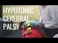 Hypotonic Cerebral Palsy Home Tips & Physiotherapy