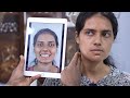 Indian Girl Genioplasty for Beauty  | Before &amp; After ( Amazing Genioplasty )