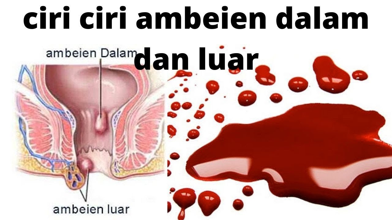 ciri ciri ambeien dalam dan luar