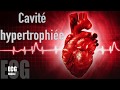 Hypertrophie ventriculaire gauche
