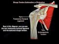 Biceps Tendon Subluxation Or Dislocation - Everything You Need To Know - Dr. Nabil Ebraheim