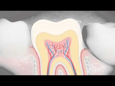 Wideo: Przyczyny czarnej płytki na zębach dziecka: leczenie