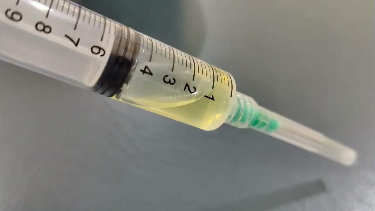 Synovial Fluid Aspirate Ganglion Cyst Ankle YouTube