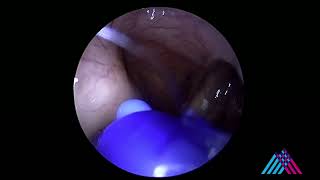 Eustachian tube balloon dilation for eustachian tube dysfunction