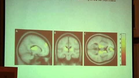 Dr. Hubbard Lecture Part 2  - Hubbard Foundation 2011 CCSVI Conference