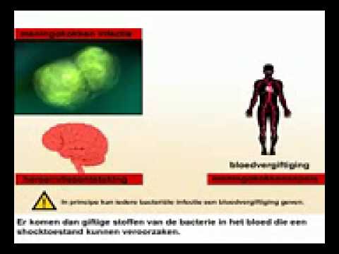 Video: Meningitis: Symptomen, Oorzaken, Typen, Behandeling, Risico's En Meer