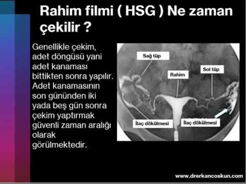 Rahim Filmi Hsg Nedir Nasıl çekilir Sonrası Nelere Dikkat Edilir Bandırma Balıkesir Bursa Tüpbebek