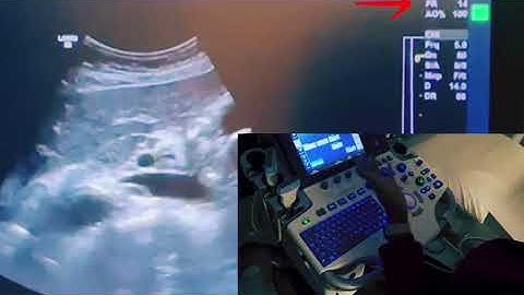 Understanding Frame Rate in Ultrasound Imaging.