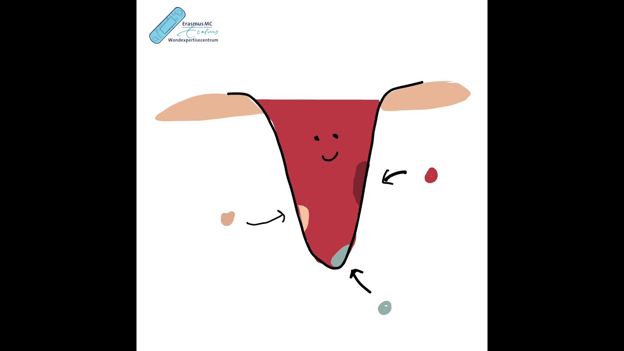 Fases wondgenezing uitgelegd