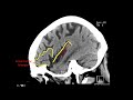 Introduction to Brain Surface Anatomy