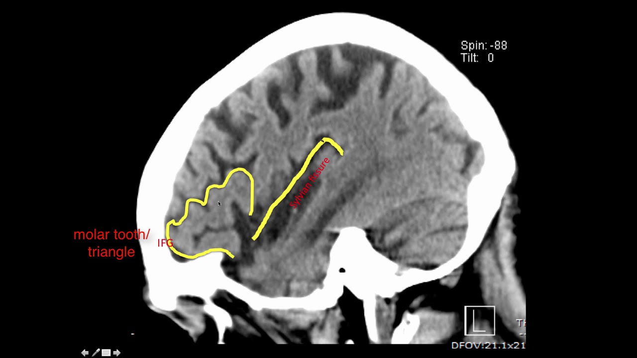 Table 1 from Case records of the Massachusetts General Hospital. Weekly  clinicopathological exercises. Case 16-2003. A 58-year-old woman with  left-sided weakness and a right frontal brain mass. | Semantic Scholar