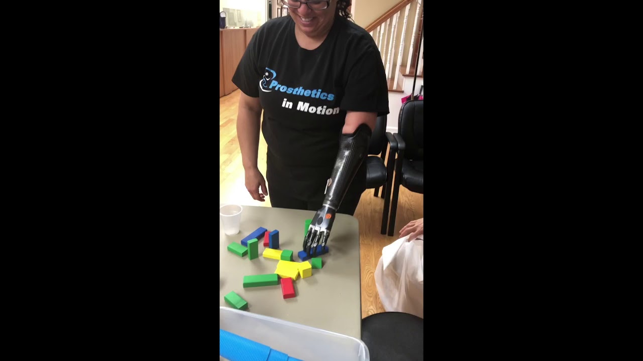 A congenital amputee uses a myoelectic prosthetic hand for the first time