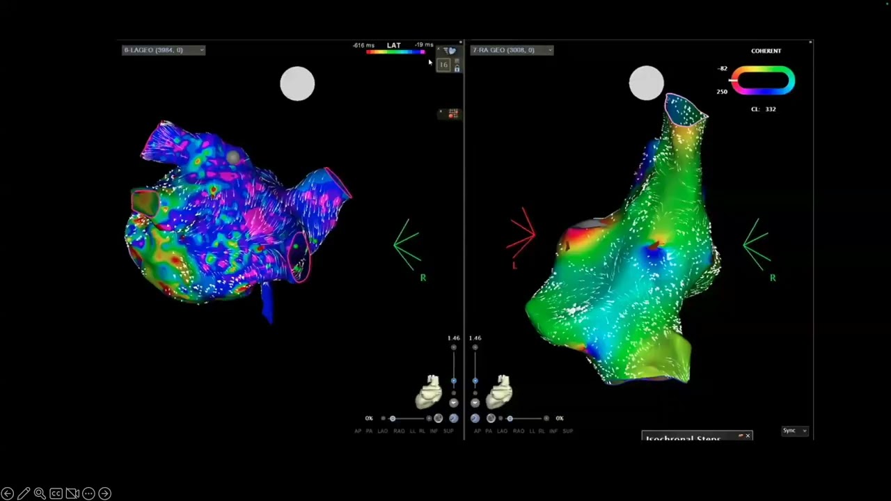 Ep15 - Updates in the Management of Acute Atrial Fibrillation - Dr. Ijeoma Ekeruo - The CVEF