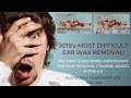 2019's MOST DIFICULT EAR WAX REMOVAL - EP 266