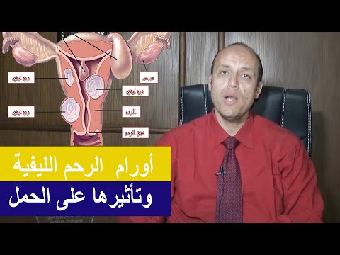 فيديو: كيفية الحمل بأورام الرحم الليفية