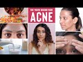 The Truth Behind Your ACNE | How To Prevent Acne NATURALLY