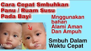 Cara Menghilangkan Panu Atau Ruam Susu
