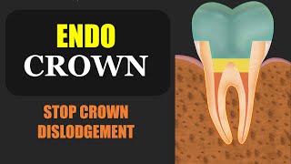 EndoCrown