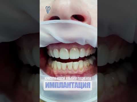 Циркониевые коронки выглядят как свои зубы. Zirconium crowns look like their teeth.