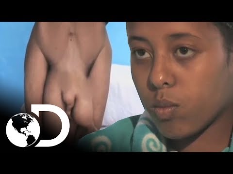 Vídeo: En Filipinas, Una Colegiala De 14 Años Vive Con Las Partes Del Cuerpo De Un Gemelo Parásito Que Le Salen Del Vientre - Vista Alternativa