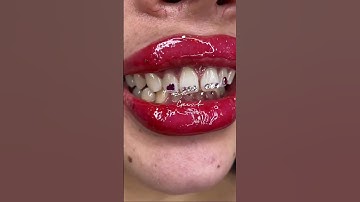 Sparkle smiles with gem accents