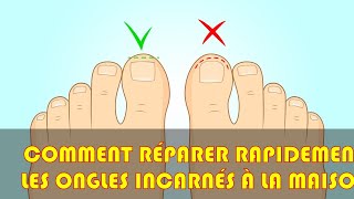 Comment réparer rapidement les ongles incarnés à la maison