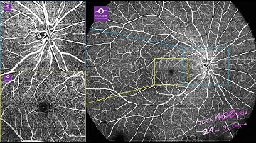 120 degree OCT Angiography detail zoom in
