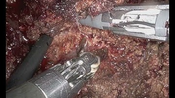 robotic R1 vascular ICG guided rehepatectomy for colorectal liver metastasis