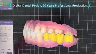 How We Digitally Design Molar Zirconia Bridge with CAD-CAM Software