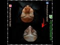 # #nosejob #pakistan #nosecorrection #rhinoplastyexpert #rhinoplastyinpakistan #drsaadatullah