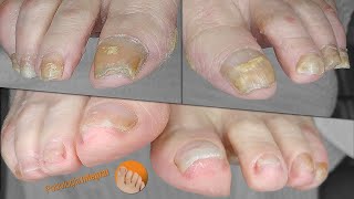 Treating complicated nails and improving their appearance through integral podology