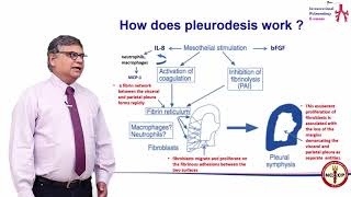 Pleurodosis - Dr Dharmesh Patel - IPeC