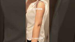 팔 지방흡입 수술전후 후기 팔 얇아지는 방법