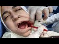 Tips in surgical extraction of wisdom tooth by drmohamed elshamaa