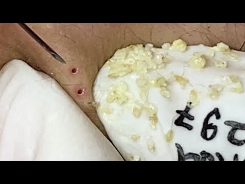 Loan Nguyen Acne Treatment (#116)