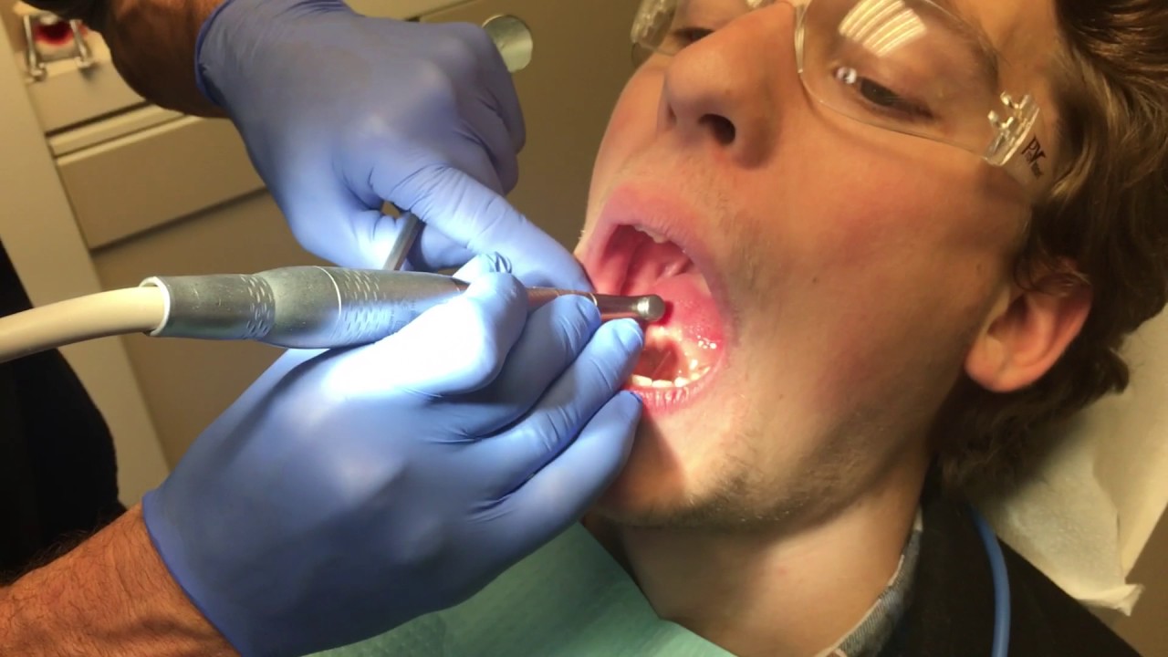 Are you considering a bone graph? Watch this first!