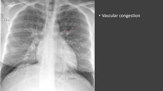 Pulmonary Edema