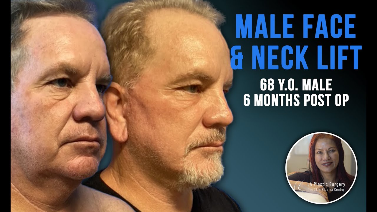 Masculine Facial Rejuvenation | 68-Year-Old Male Facelift Transformation