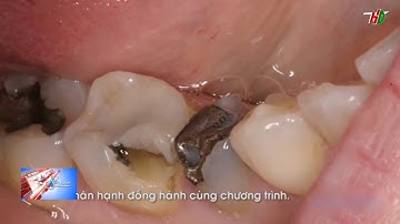 Phương pháp inlay - onlay trong điều trị sâu răng